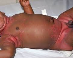 Baby-with-eczema