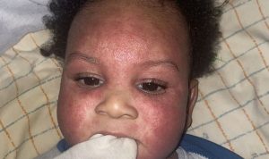 Baby-with-eczema