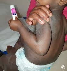 Formula for Babies with Eczema