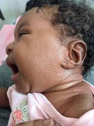 Formula for Babies with Eczema 